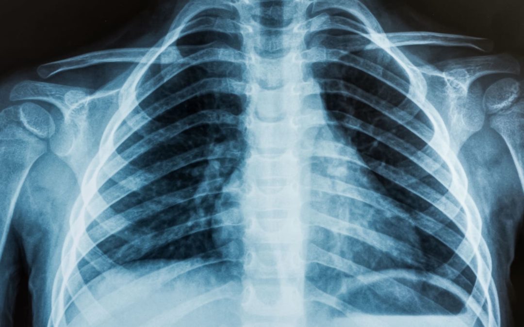 A.I. Predicts Heart Attack Risk Using X-ray