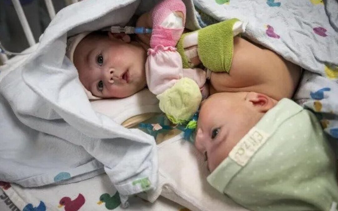 Twins Going Home After Separation Surgery