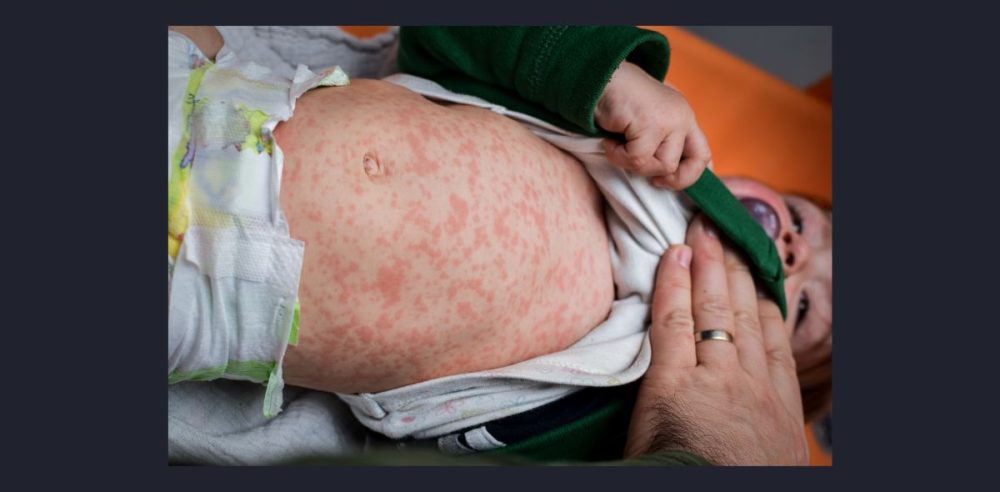 Texas Faces Measles Outbreak As Cases Rise; Public Health Officials Warn Of Continued Spread